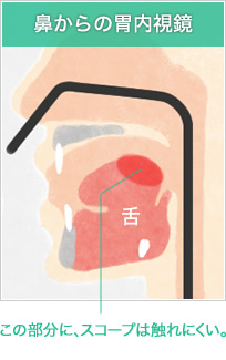 鼻からの胃内視鏡