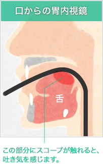 口からの胃内視鏡