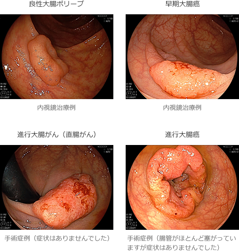 大腸がんについて