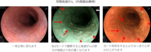 食道がん症例