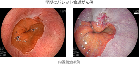 早期の食道バレット腺がん例