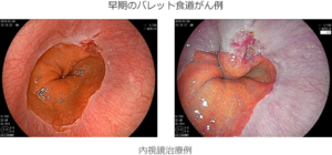 食道がん症例
